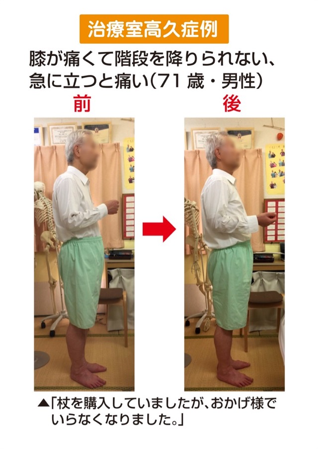 膝が痛くて階段を降りられない 急に立つと痛い 71歳 男性 本格整体院高久 大泉学園店