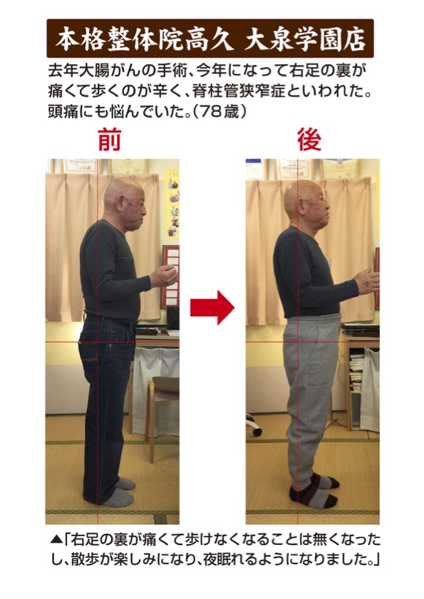 ７８歳男性　右足の痛み治った頭痛も治った